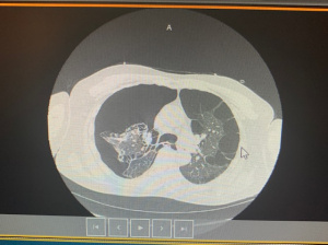 PneumothoraxCT.jpg