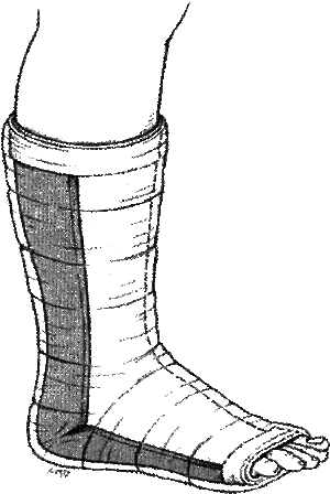 Posterior Ankle Splint.gif