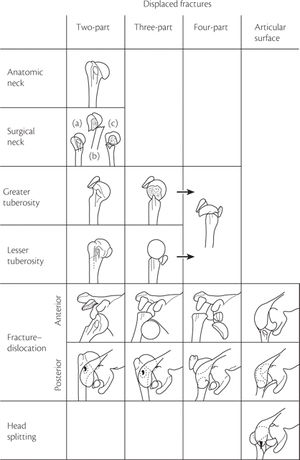 Prox humerus fracture.jpeg