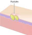 Pustules.png