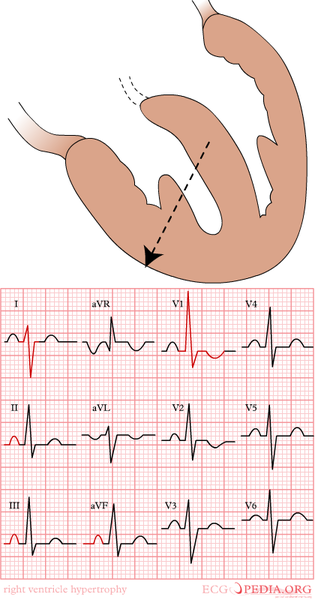 File:RVH.png