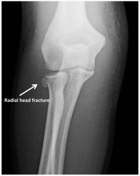 File:Radial Head Fracture.png