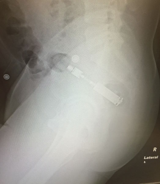 File:Rectal fb.JPG