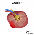 Grade I