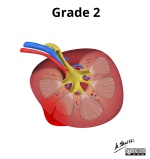 Grade II