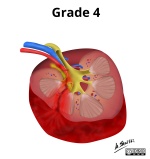 Grade IV