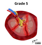 Grade V
