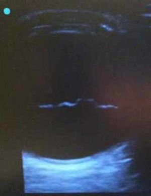 RetinalDetachment.jpeg