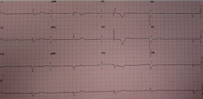 File:Rhythm 3rdAVblock.jpg