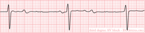 Rhythm 3rdAVblock.png