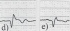 STEMI-d.jpg