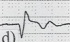STEMI-d2.jpg