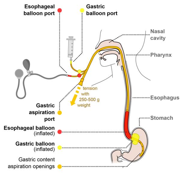File:Sengstaken-Blakemore scheme EN.png