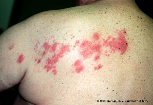 Shingles