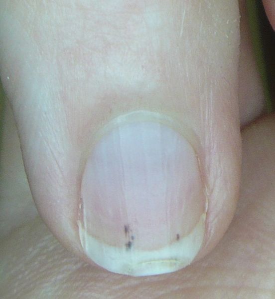 File:Splinter hemorrhage.jpg