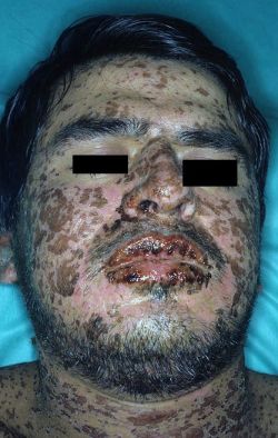 Stevens-johnson-syndrome.jpg