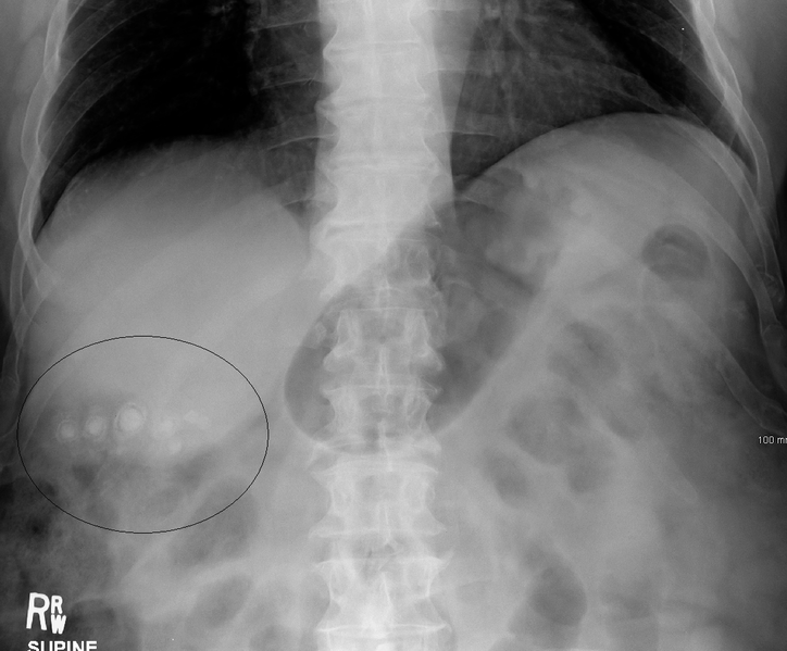 File:StonesXray.png