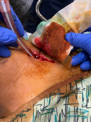 Surgical cricothyrotomy.JPG