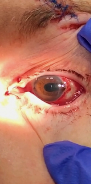Teardrop pupil.jpg