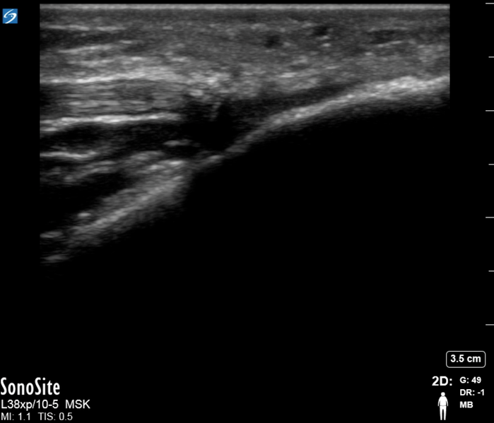 File:Tendon Rupture 2.png