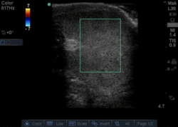 Absent testicular blood flow