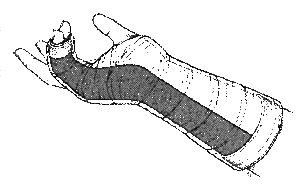 Ulna Gutter 2.gif