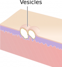 Vesicles (2).png