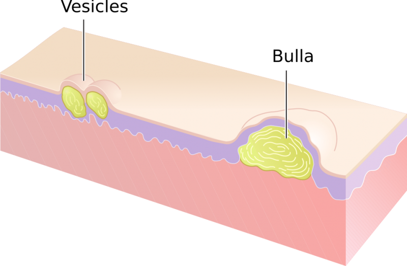 File:Vesicles and Bulla.png