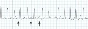 Wandering atrial pacemaker.JPG