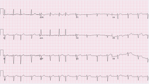Wandering atrial pacemaker.png