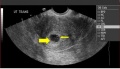 Yolk sac.jpg